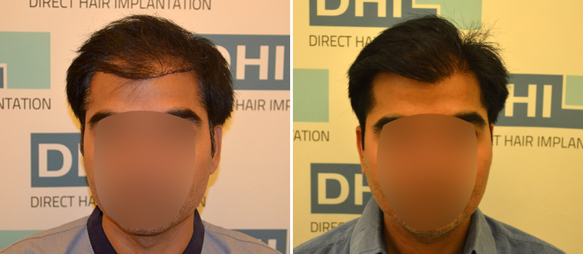 DHI before & after hair transplant results